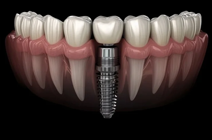 Dental Implants & Fixed Teeth-----0